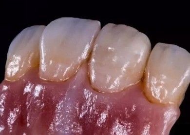 เยอรมัน Amanjilbach Zirconia ฟันมงคลความหนาแน่นสูง