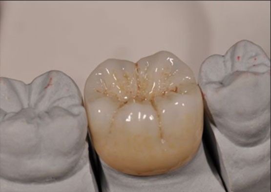 ความสวยงามสูง Noritake Zirconia สีธรรมชาติมั่นคงสําหรับครอบครอบ Zirconia